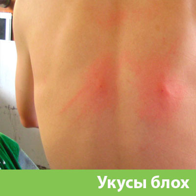 Укусы блох в Тобольске