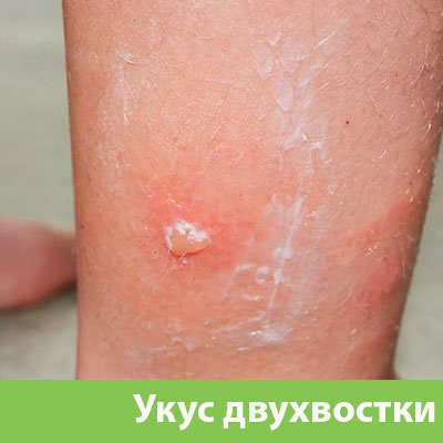 Укус двухвостки в Тобольске