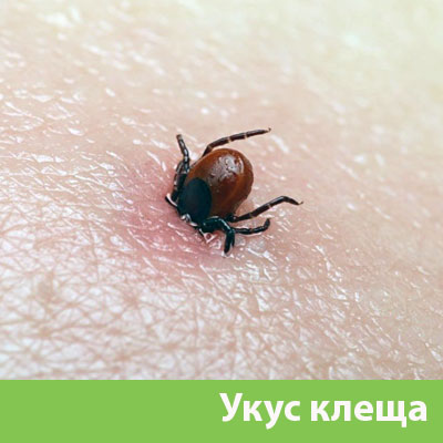 Укус клеща в Тобольске