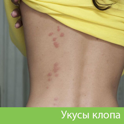 Профессиональное уничтожение клопов в Тобольске